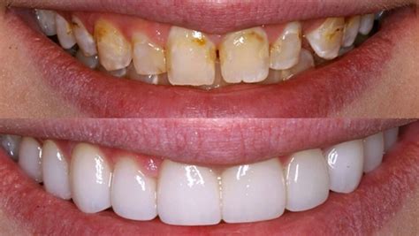 Giải pháp BỌC RĂNG SỨ THẨM MỸ .